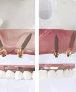 Скуловая имплантация Zygoma или V-II-V: помогаем выбрать